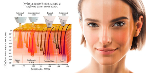 Особенности и достоинства диодного лазера для эпиляции